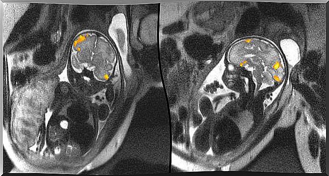 MRI of a fetus